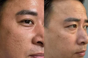 Điều trị sẹo rỗ bằng Laser: Giải pháp hiệu quả và những điều cần biết để lấy lại làn da mịn màng