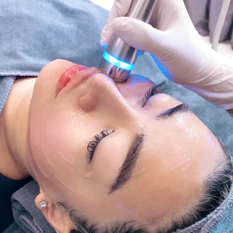 "Giải cứu" làn da khỏi mụn trứng cá bằng công nghệ cao – Những lựa chọn hàng đầu