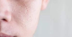Công nghệ điều trị lỗ chân lông to nào hiệu quả nhất? Review các phương pháp hiện đại