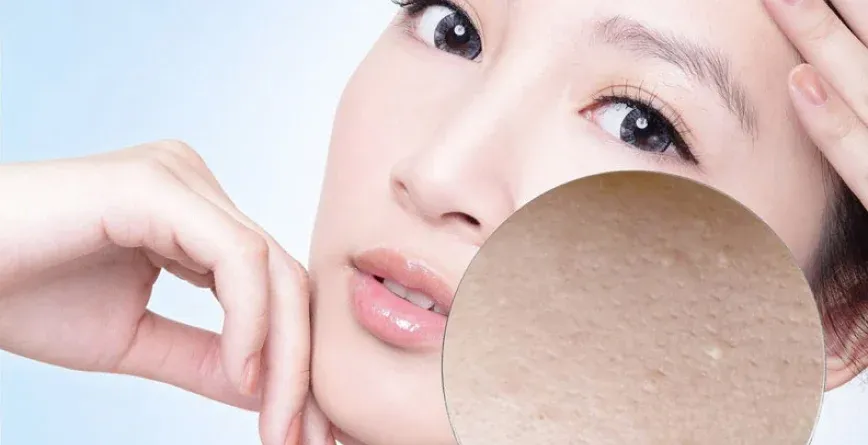 Mụn là gì và tại sao chúng ta cần điều trị mụn?