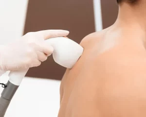 Công nghệ điều trị mụn lưng hiệu quả nhất 2025? Bí quyết cho làn da lưng mịn màng