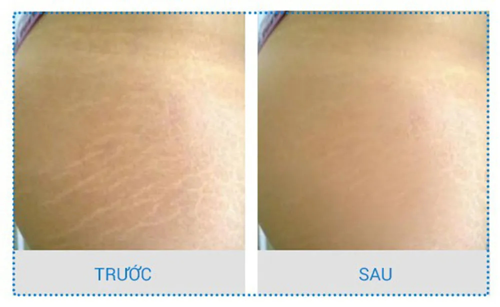 Chăm Sóc Da Tại Nhà Sau Liệu Trình Công Nghệ