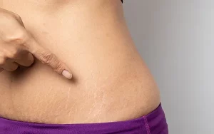  Công Nghệ Điều Trị Rạn Da Sau Sinh: Lấy Lại Làn Da Mịn Màng Cho Mẹ Bỉm Sữa