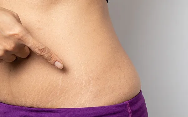 Các Công Nghệ Điều Trị Rạn Da Sau Sinh Hiện Đại và Hiệu Quả