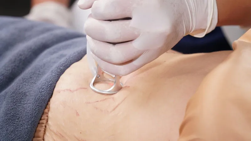 Vì Sao Rạn Da Sau Sinh Là Nỗi Lo Của Nhiều Mẹ?