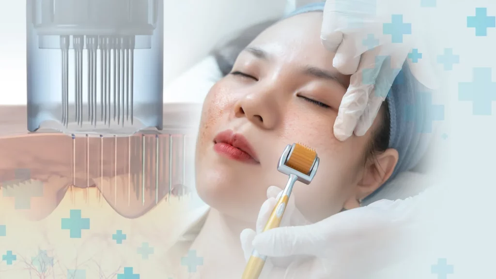 Lời khuyên từ chuyên gia: Làm thế nào để chọn công nghệ điều trị mụn hiệu quả nhất cho bạn?