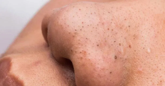 Những điều cần lưu ý trước và sau khi điều trị mụn đầu đen bằng công nghệ cao