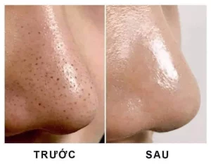 Công nghệ trị mụn đầu đen hiệu quả nhất hiện nay? Bí quyết cho làn da sạch mịn