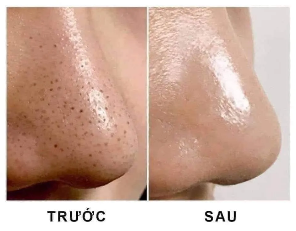 "Gạt bỏ" mụn đầu đen với công nghệ hiện đại – Top lựa chọn cho làn da sạch thoáng