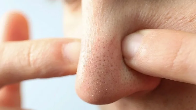 Mụn đầu đen là gì và tại sao chúng "lì lợm" đến vậy?