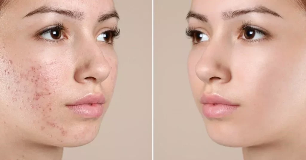 Công Nghệ Trị Mụn Không Để Lại Thâm: Bí Quyết Cho Làn Da Sạch Mụn, Rạng Ngời