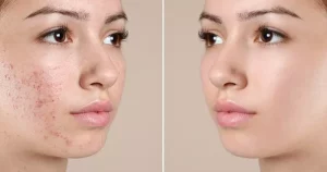 Công Nghệ Trị Mụn Không Để Lại Thâm: Bí Quyết Cho Làn Da Sạch Mụn, Rạng Ngời