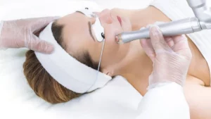 Công nghệ trị nám bằng Laser Toning: Giải pháp hiệu quả cho làn da đều màu