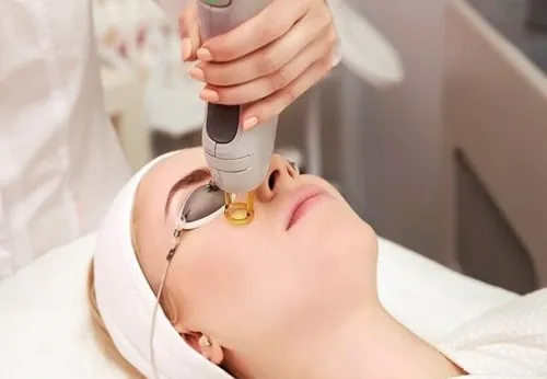 Laser Toning là gì? Cơ chế "tinh tế" trong điều trị nám