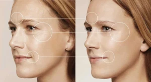 Công nghệ xóa nếp nhăn nào hiệu quả nhất 2025? Bí quyết cho làn da không tuổi