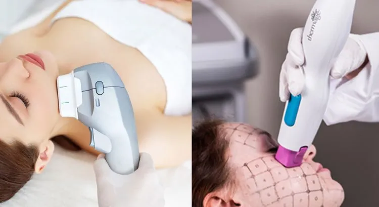 Chi phí điều trị da bằng công nghệ Thermage là bao nhiêu?
