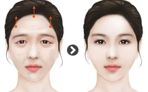 Điều trị da bằng công nghệ Thermage là gì? Hiệu quả, quy trình và những điều cần biết