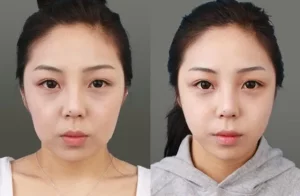 Điều trị da chảy xệ không phẫu thuật: Top công nghệ hiệu quả nhất 2025