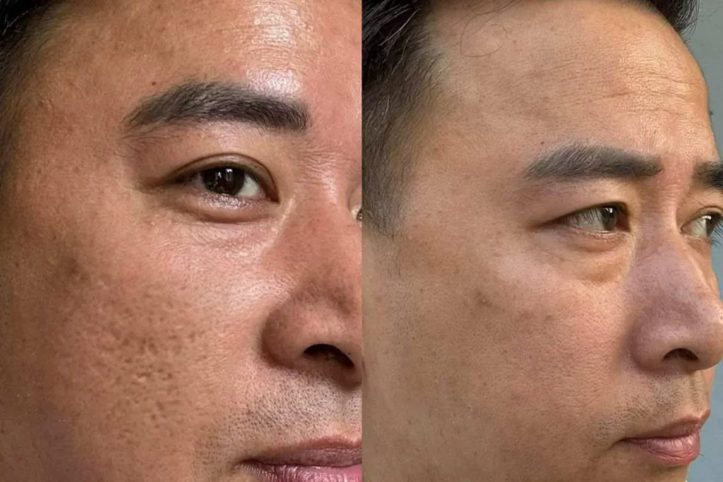 Điều trị sẹo rỗ bằng Laser: Giải pháp hiệu quả và những điều cần biết để lấy lại làn da mịn màng