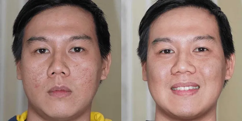 Sẹo rỗ là gì và tại sao chúng ta cần điều trị sẹo rỗ?