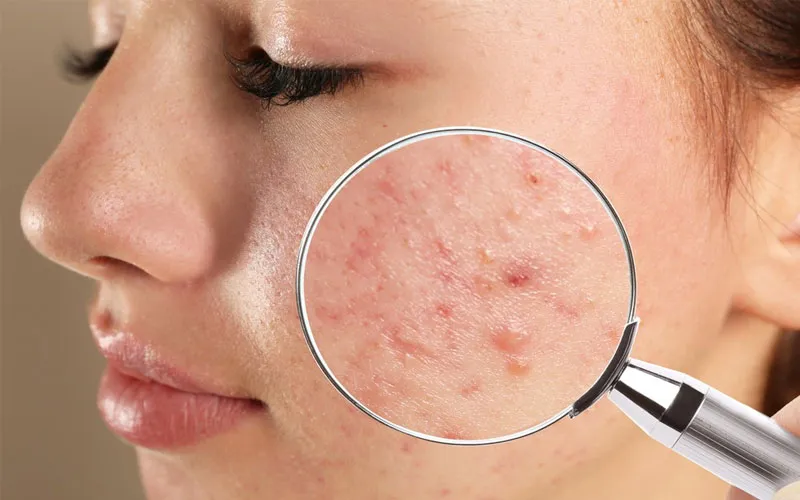 Công nghệ điều trị mụn nội tiết nào hiệu quả nhất hiện nay? Giải pháp từ chuyên gia